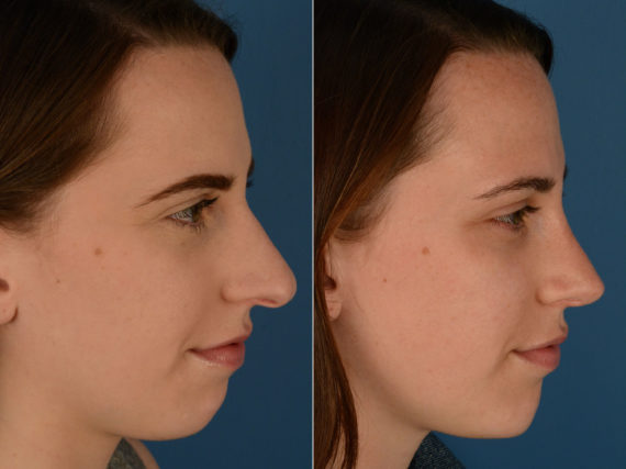 Rhinoplasty Before and After Photos in Naples, FL, Patient 15521