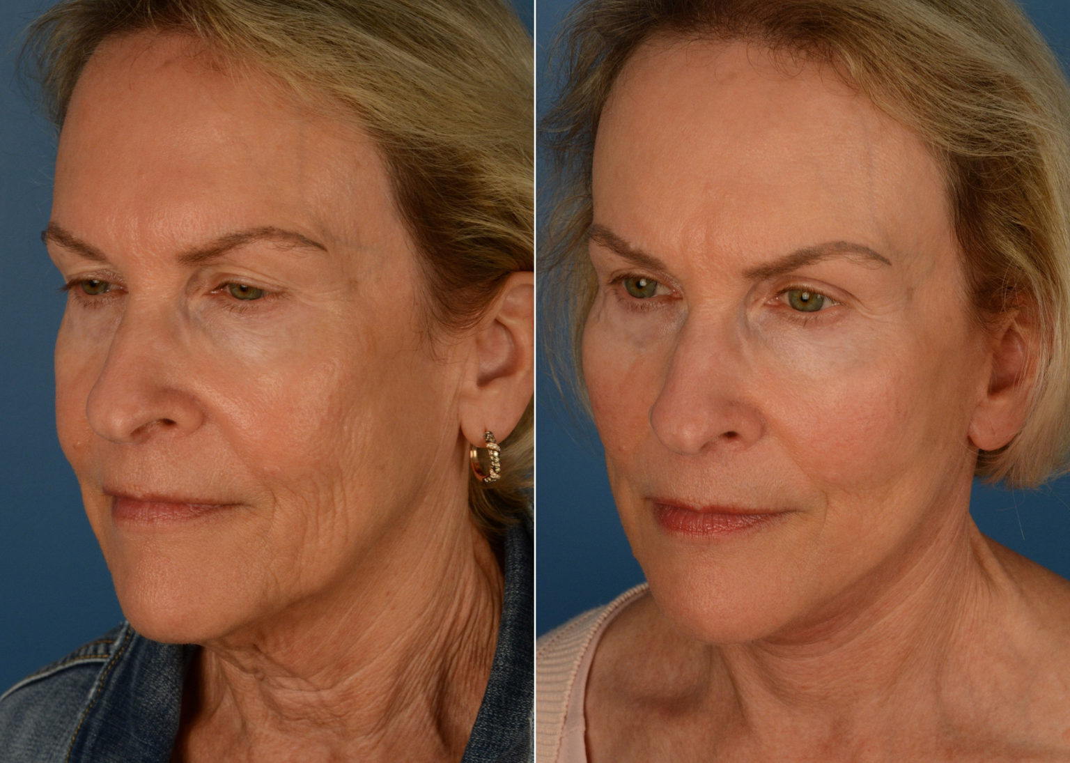 Endoscopic Facelift Photos Naples, FL Patient 15546