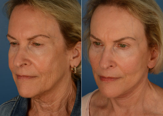 Endoscopic Facelift Before and After Photos in Naples, FL, Patient 15546