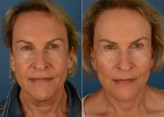 Endoscopic Facelift Before and After Photos in Naples, FL, Patient 15546