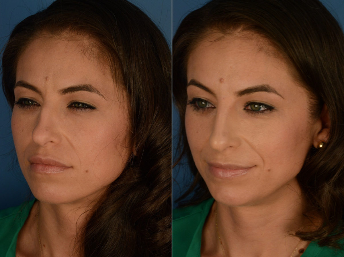 Injectable Filler Rhinoplasty Before and After Photos in Naples, FL, Patient 15590