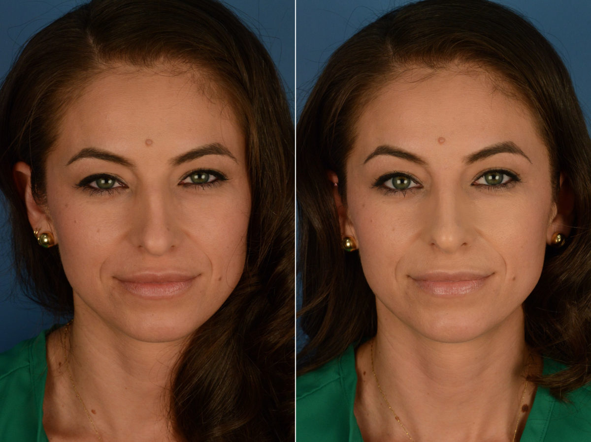 Injectable Filler Rhinoplasty Before and After Photos in Naples, FL, Patient 15590