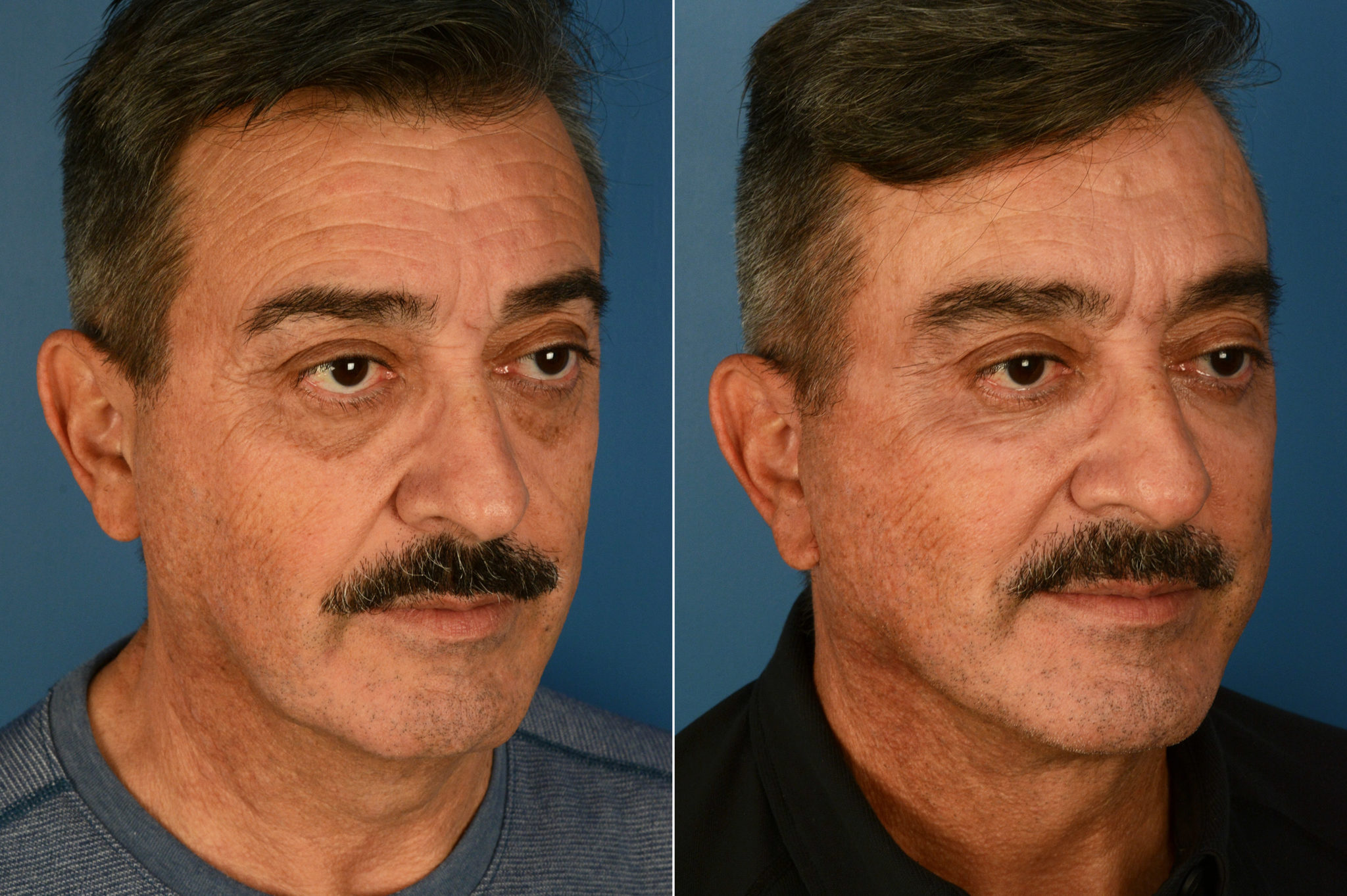Endoscopic Facelift, Endoscopic Facelift Male Photos Naples, FL