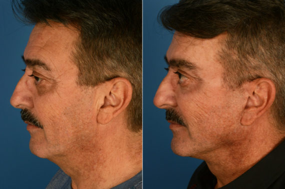 Endoscopic Facelift Before and After Photos in Naples, FL, Patient 16017