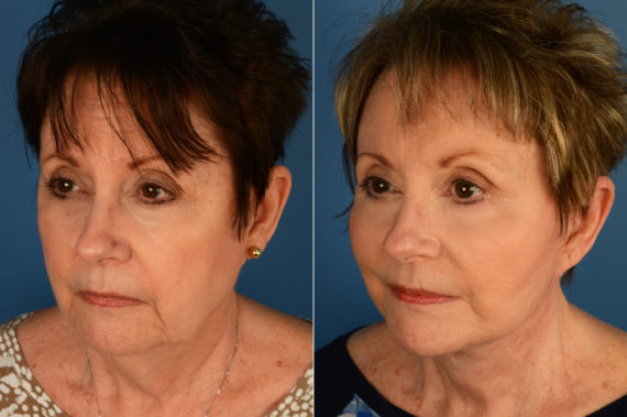 Endoscopic Facelift Before and After Photos in Naples, FL, Patient 16052