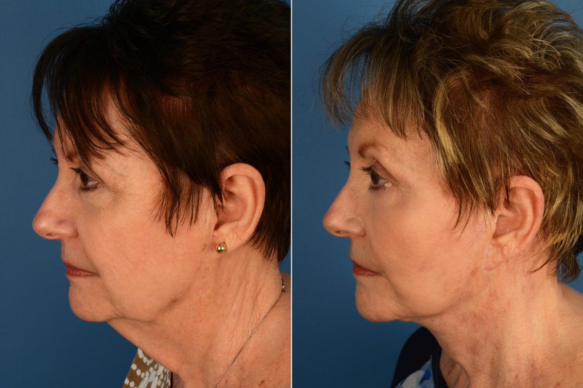 Endoscopic Facelift Before and After Photos in Naples, FL, Patient 16052