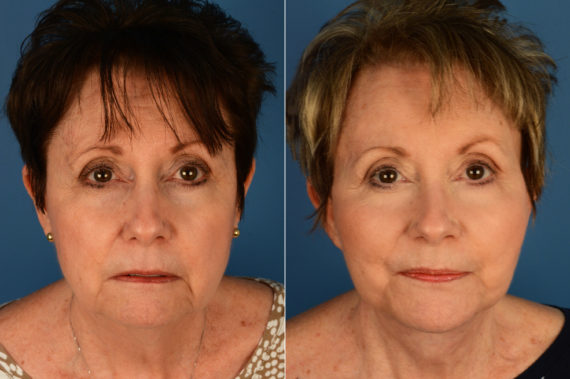 Endoscopic Facelift Before and After Photos in Naples, FL, Patient 16052