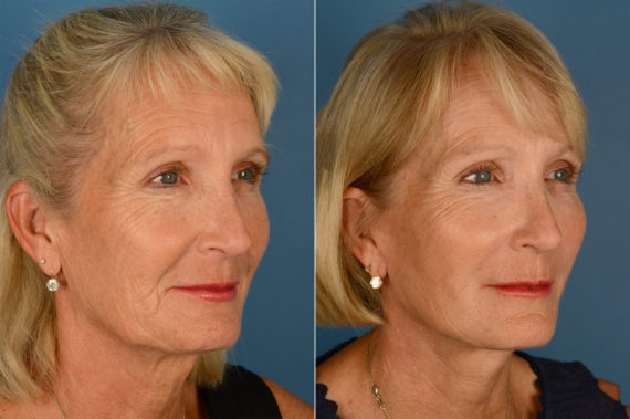 Endoscopic Facelift Before and After Photos in Naples, FL, Patient 16066