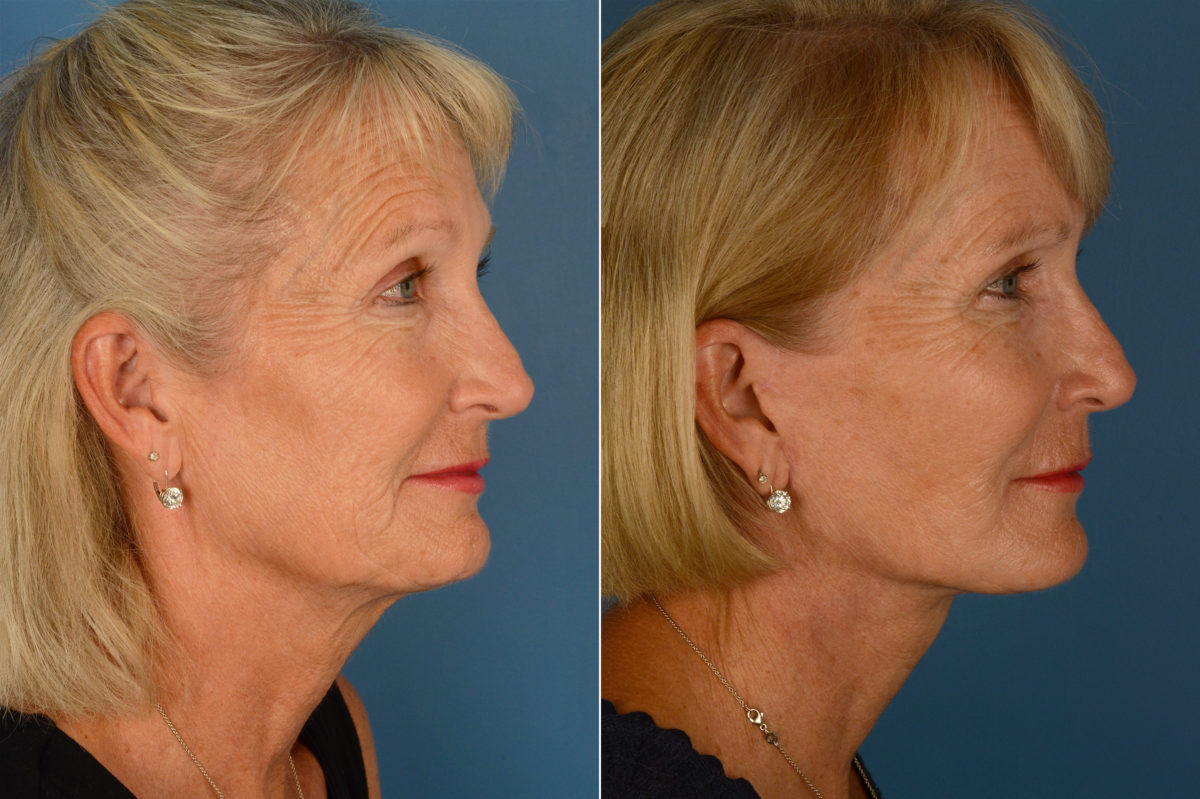 Endoscopic Facelift Before and After Photos in Naples, FL, Patient 16066