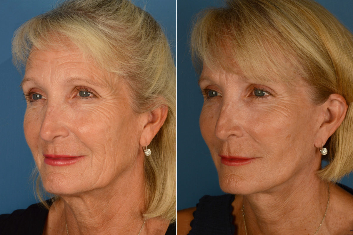 Endoscopic Facelift Before and After Photos in Naples, FL, Patient 16066