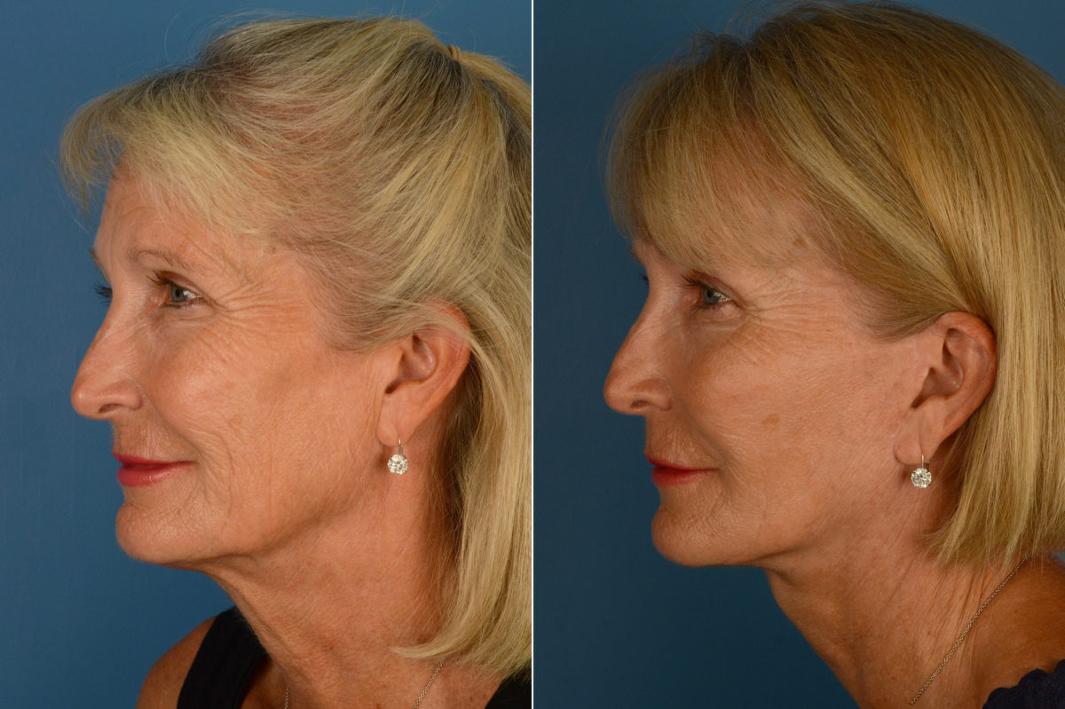 Endoscopic Facelift Before and After Photos in Naples, FL, Patient 16066