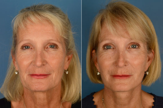 Endoscopic Facelift Before and After Photos in Naples, FL, Patient 16066