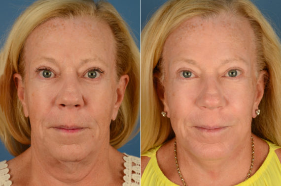 Chin Implant Before and After Photos in Naples, FL, Patient 16103
