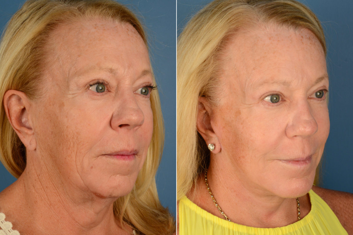Chin Implant Before and After Photos in Naples, FL, Patient 16103