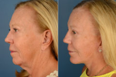 Chin Implant Before and After Photos in Naples, FL, Patient 16103