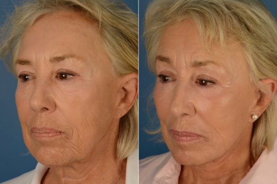 CO2 Laserwash Before and After Photos in Naples, FL, Patient 16172
