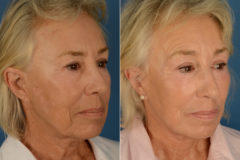 CO2 Laserwash Before and After Photos in Naples, FL, Patient 16172