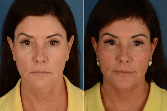 Endoscopic Facelift Before and After Photos in Naples, FL, Patient 16202