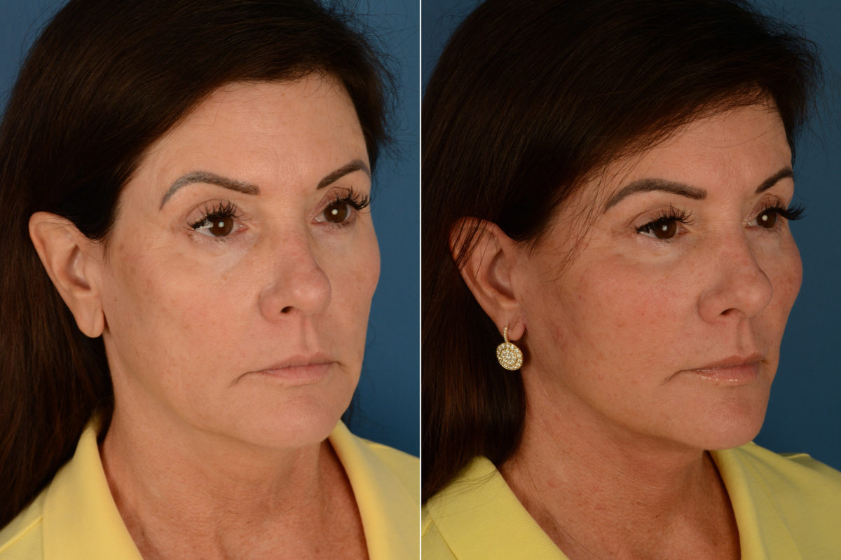Endoscopic Facelift Before and After Photos in Naples, FL, Patient 16202