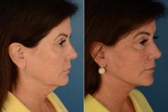 Endoscopic Facelift Before and After Photos in Naples, FL, Patient 16202