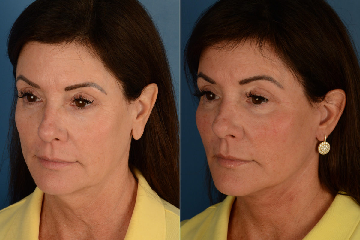 Endoscopic Facelift Before and After Photos in Naples, FL, Patient 16202
