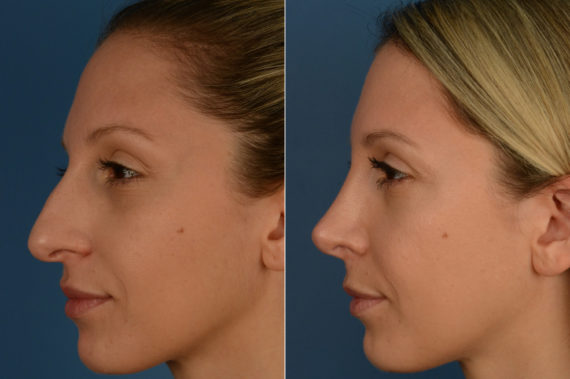 Rhinoplasty Before and After Photos in Naples, FL, Patient 16340