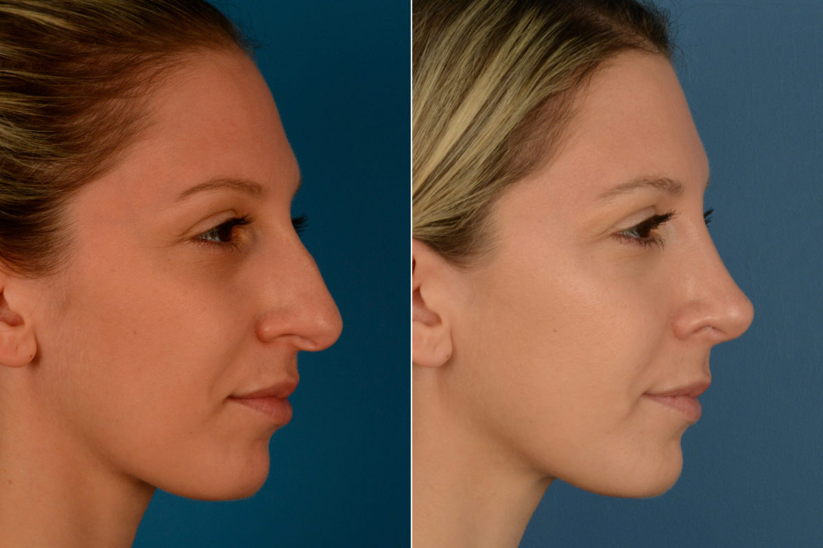 Rhinoplasty Before and After Photos in Naples, FL, Patient 16340
