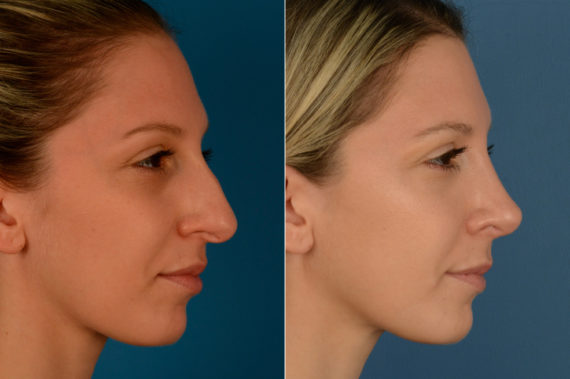 Rhinoplasty Before and After Photos in Naples, FL, Patient 16340
