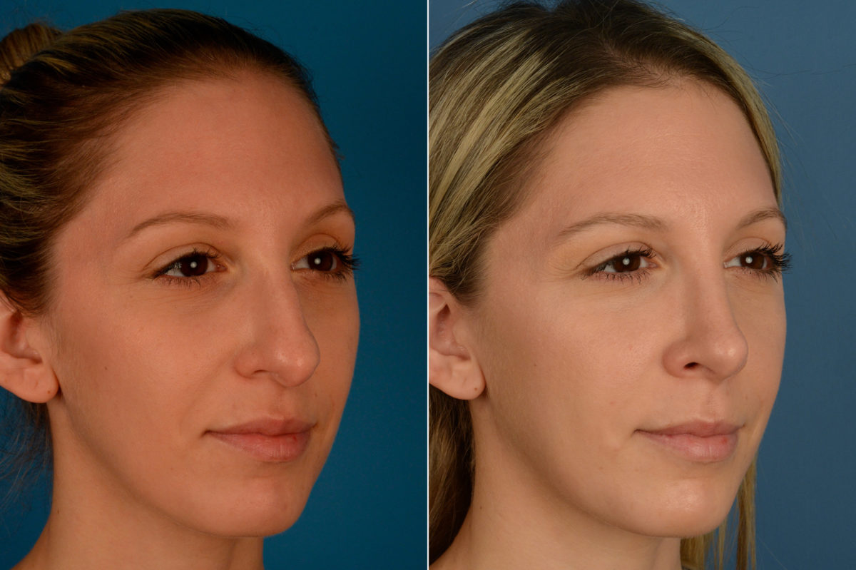 Rhinoplasty Before and After Photos in Naples, FL, Patient 16340