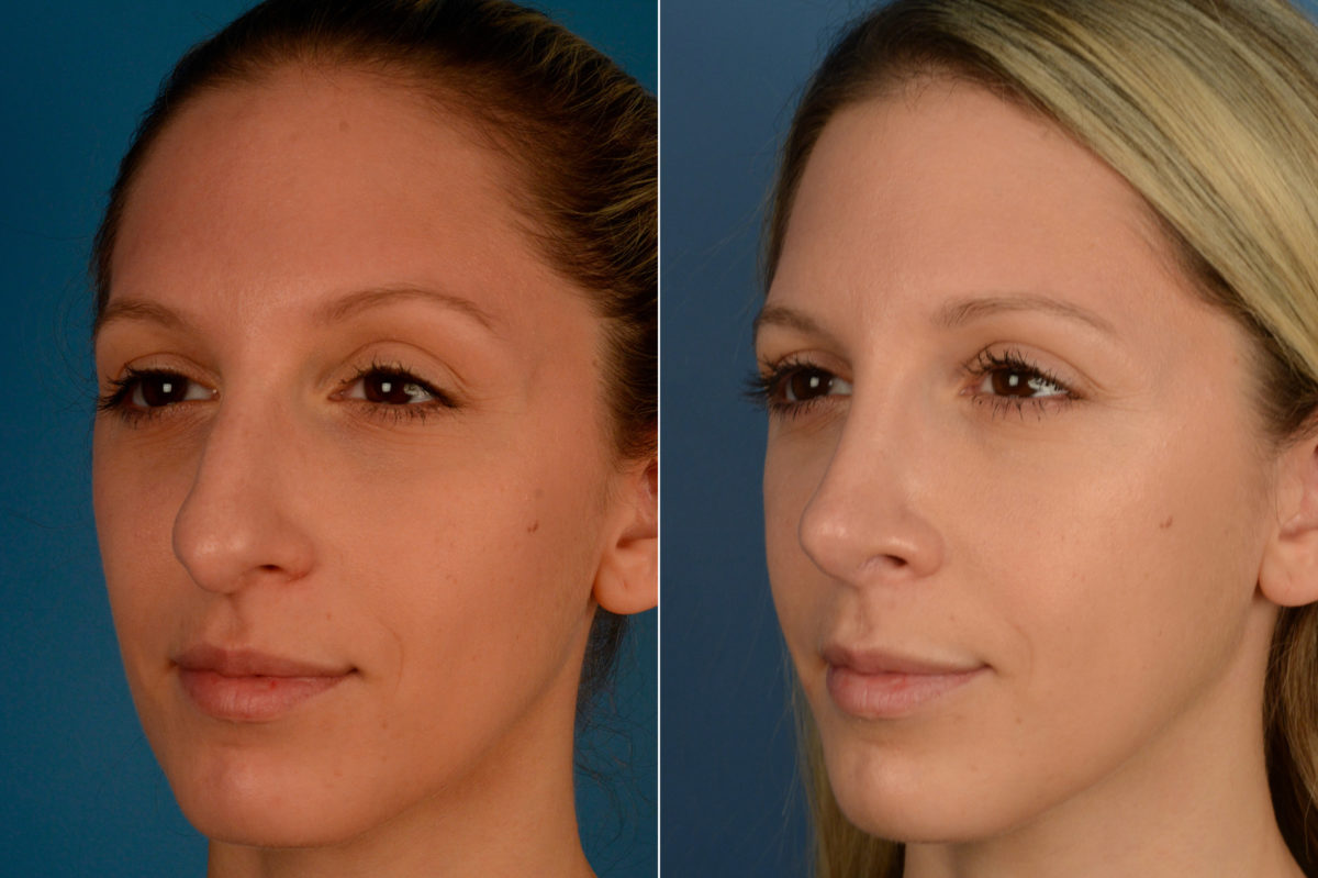 Rhinoplasty Before and After Photos in Naples, FL, Patient 16340