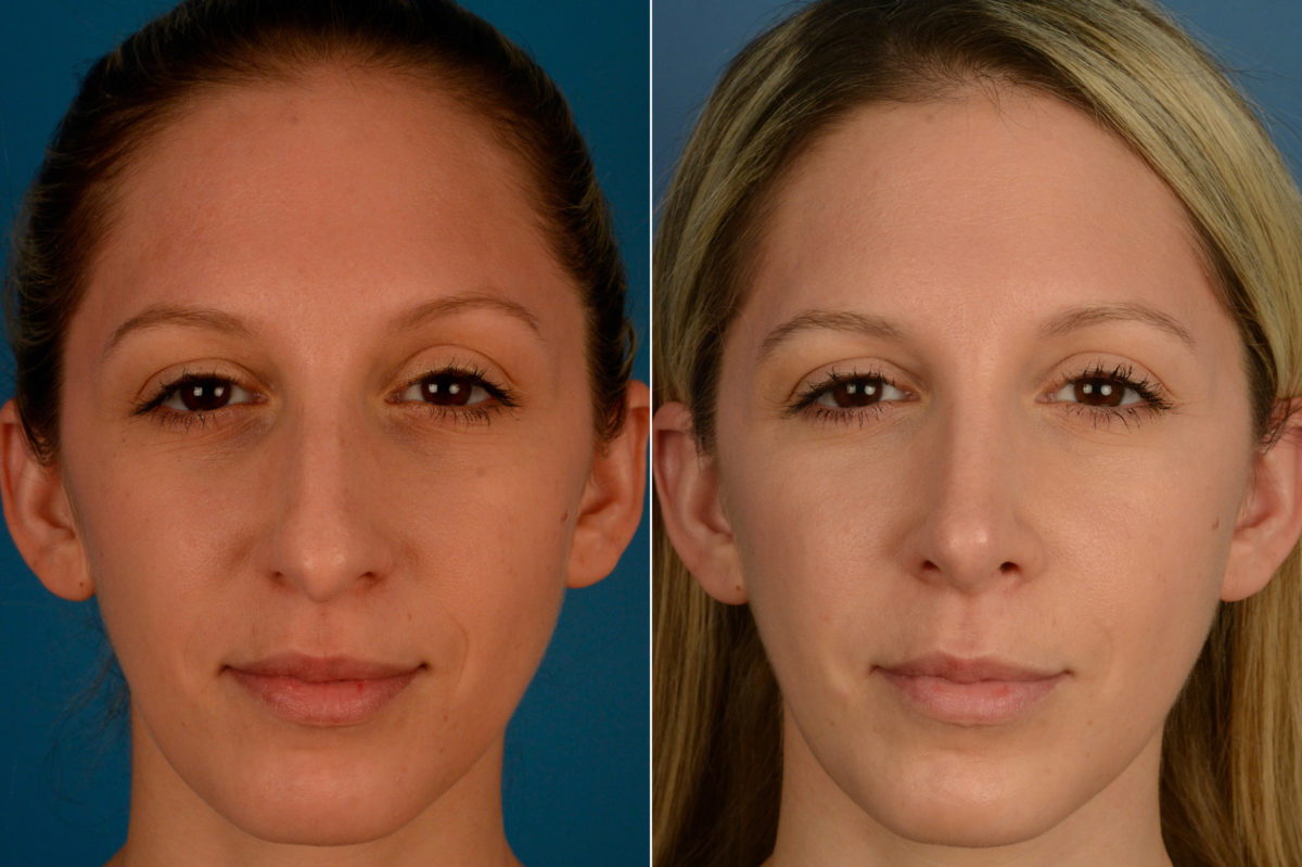 Rhinoplasty Before and After Photos in Naples, FL, Patient 16340