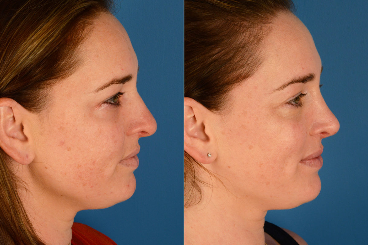 Rhinoplasty Before and After Photos in Naples, FL, Patient 16357