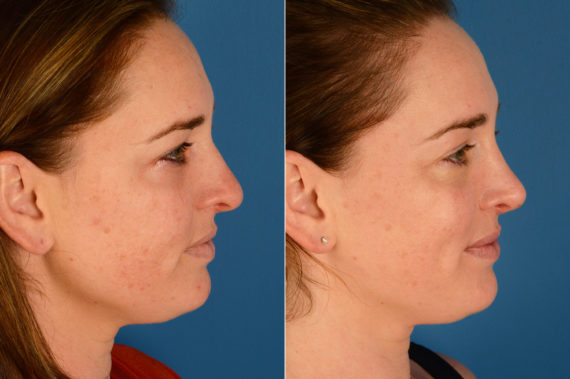 Rhinoplasty Before and After Photos in Naples, FL, Patient 16357