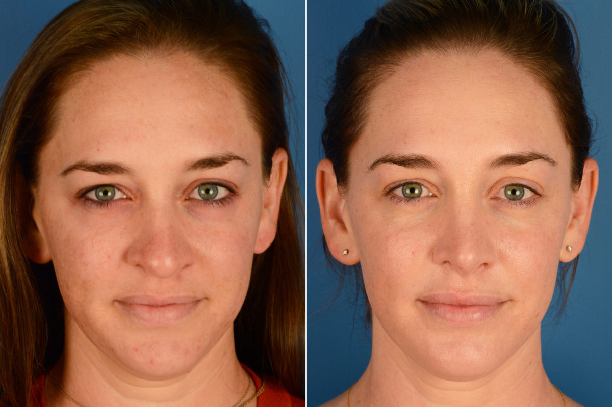 Rhinoplasty Before and After Photos in Naples, FL, Patient 16357
