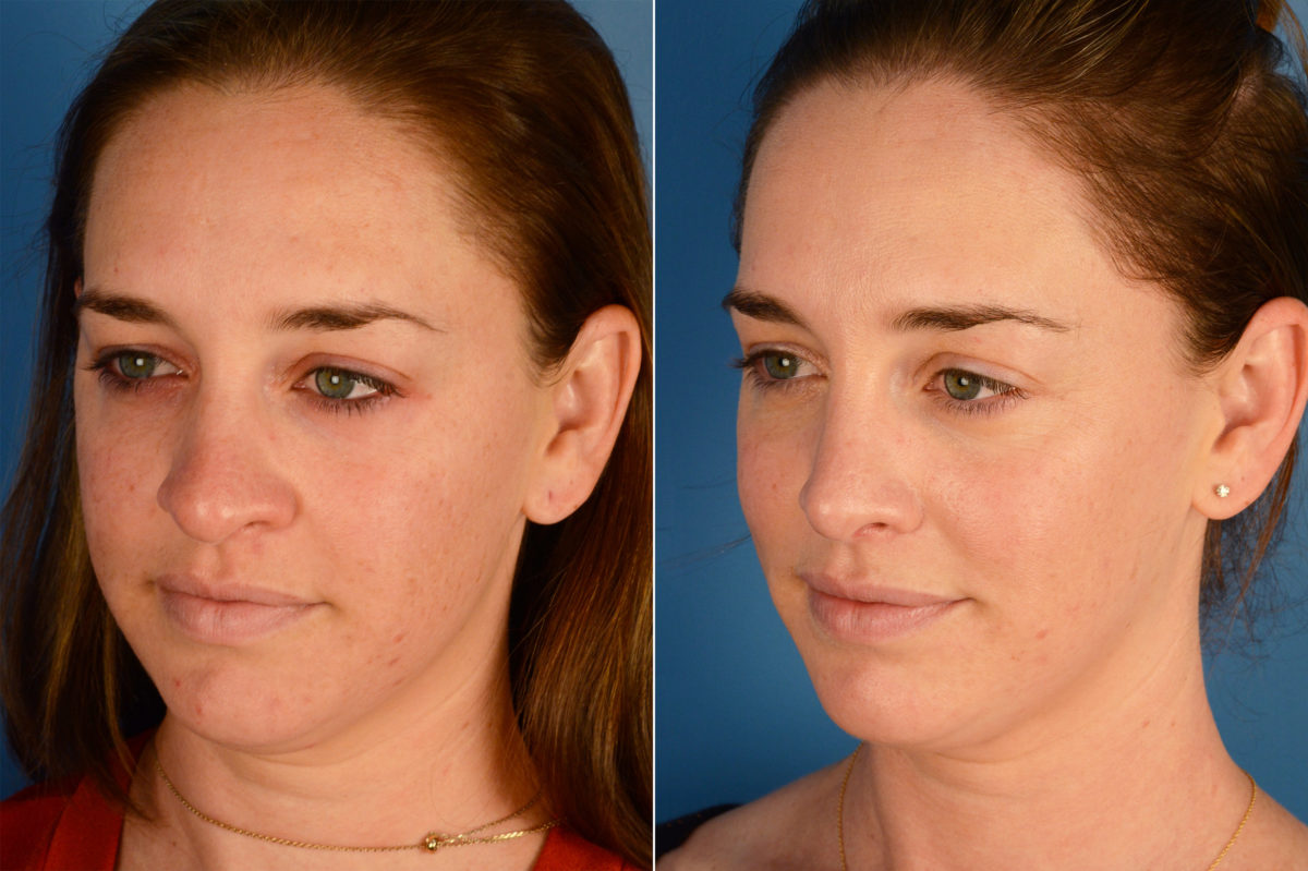 Rhinoplasty Before and After Photos in Naples, FL, Patient 16357