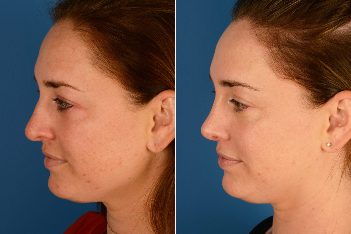 Rhinoplasty Before and After Photos in Naples, FL, Patient 16357