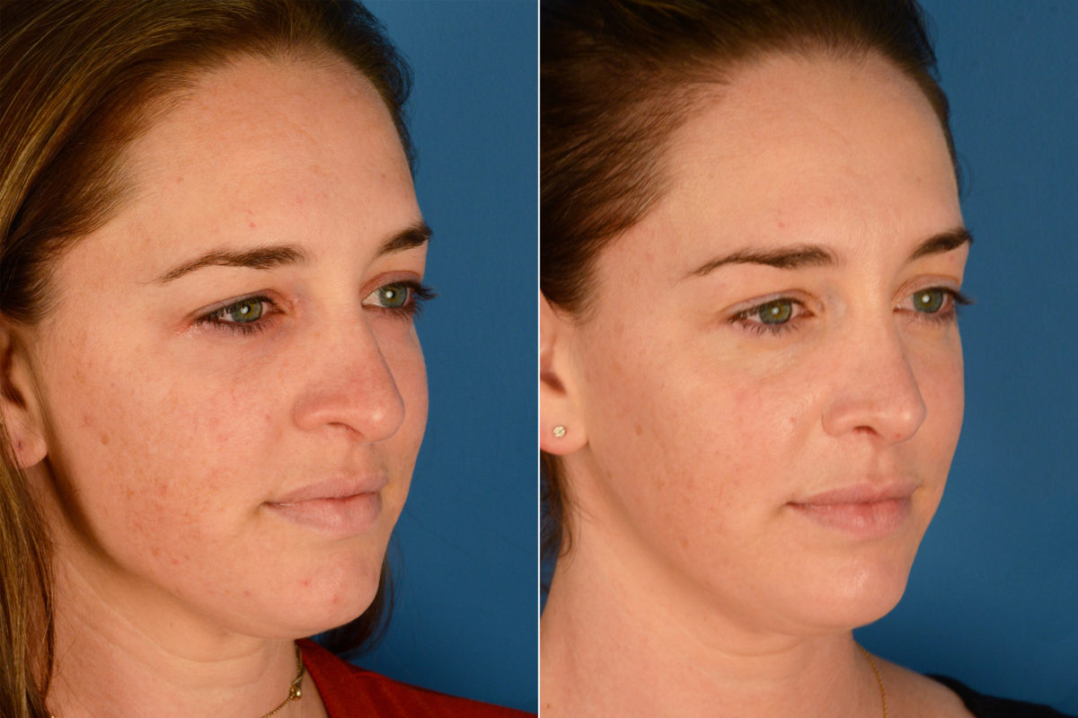 Rhinoplasty Before and After Photos in Naples, FL, Patient 16357