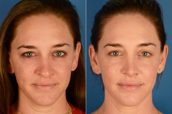 Rhinoplasty Before and After Photos in Naples, FL, Patient 16357