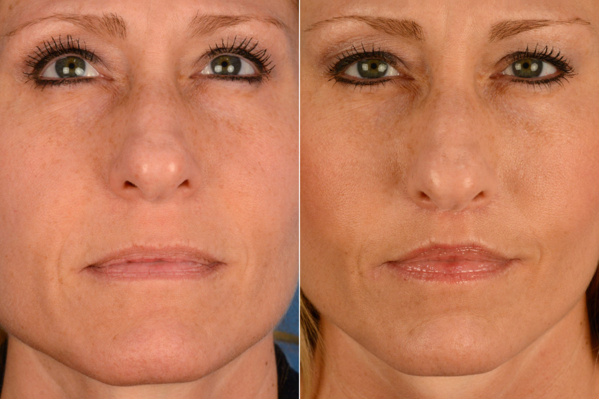 Lip Lift Before and After Photos in Naples, FL, Patient 16408