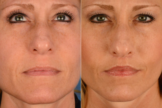 Lip Lift Before and After Photos in Naples, FL, Patient 16408