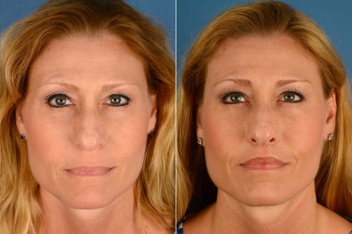 Lip Lift Before and After Photos in Naples, FL, Patient 16408