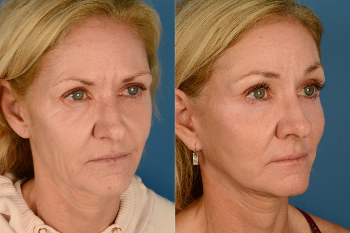 Endoscopic Facelift Before and After Photos in Naples, FL, Patient 16682