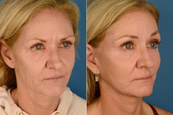 Endoscopic Facelift Before and After Photos in Naples, FL, Patient 16682