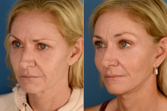 Endoscopic Facelift Before and After Photos in Naples, FL, Patient 16682