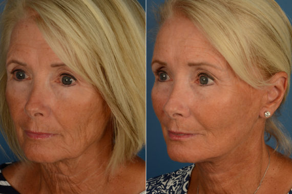 Endoscopic Facelift Before and After Photos in Naples, FL, Patient 16858