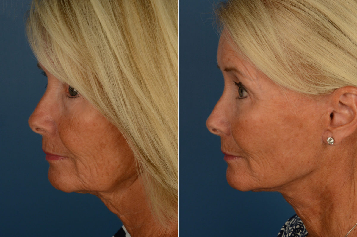 Endoscopic Facelift Before and After Photos in Naples, FL, Patient 16858