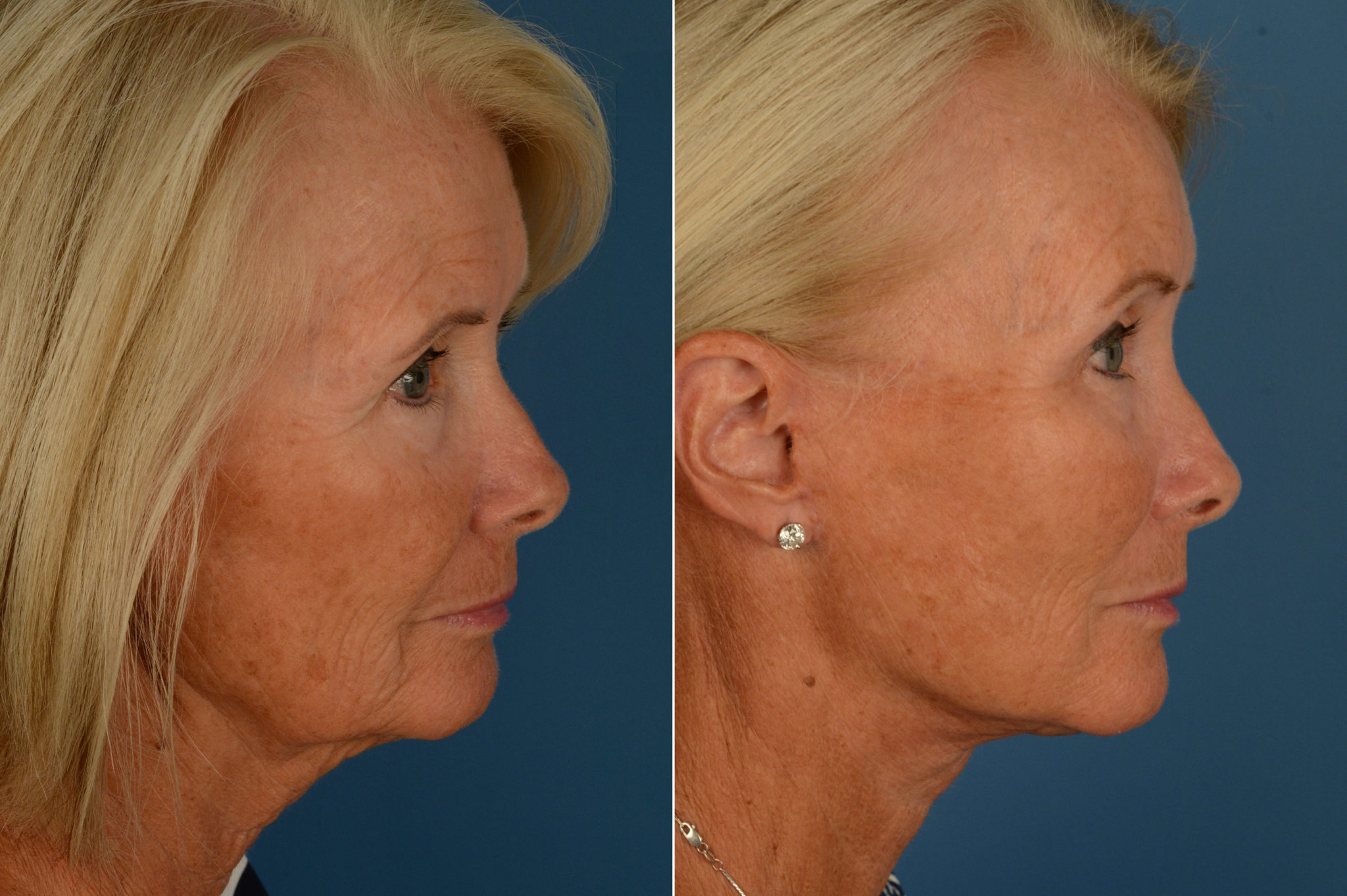 Endoscopic Facelift Photos Naples, FL Patient 16858