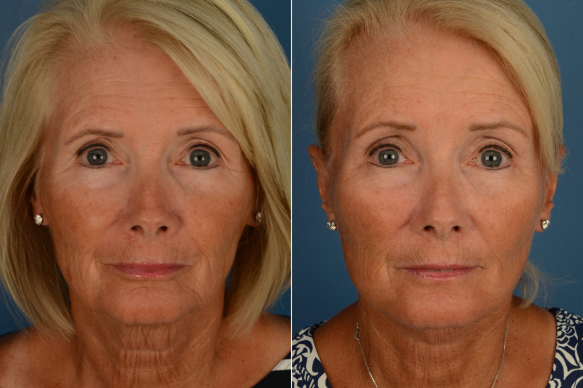 Endoscopic Facelift Before and After Photos in Naples, FL, Patient 16858