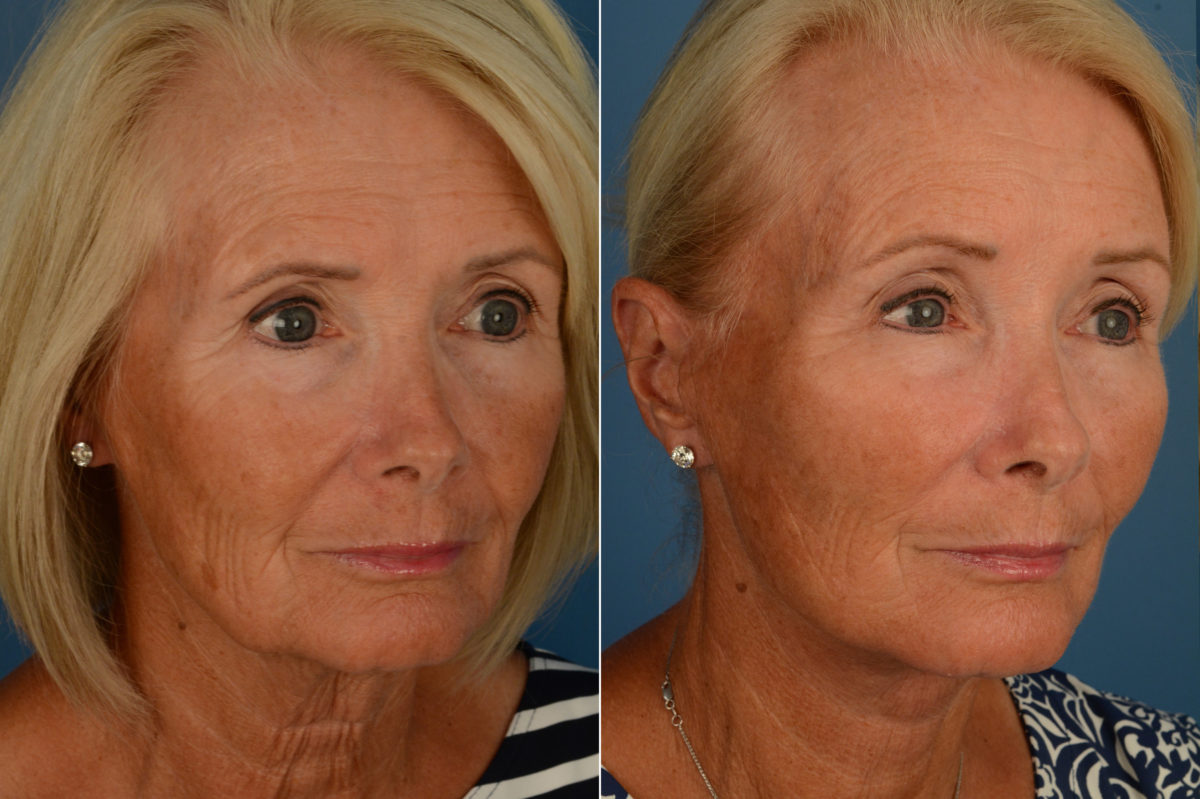 Endoscopic Facelift Before and After Photos in Naples, FL, Patient 16858