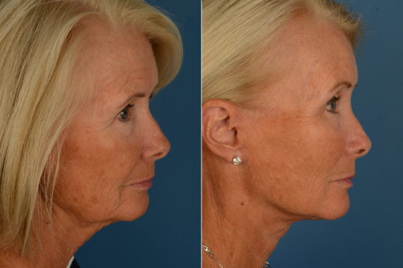 Endoscopic Facelift Before and After Photos in Naples, FL, Patient 16858